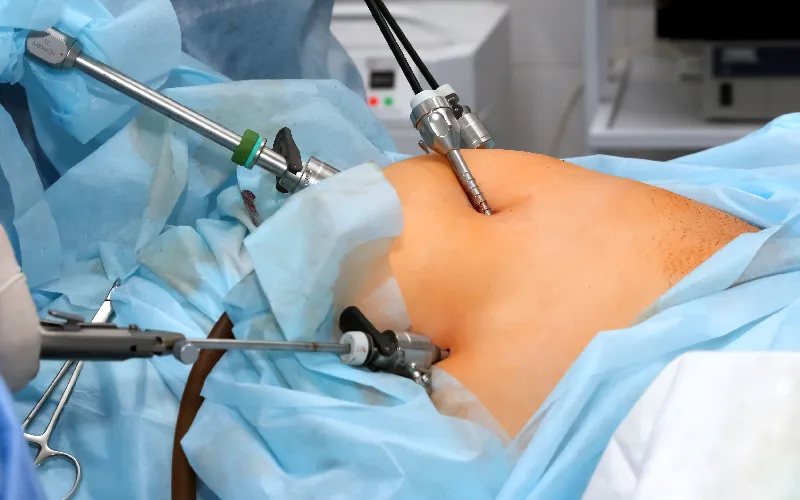 Laparoscopic fibroid removal